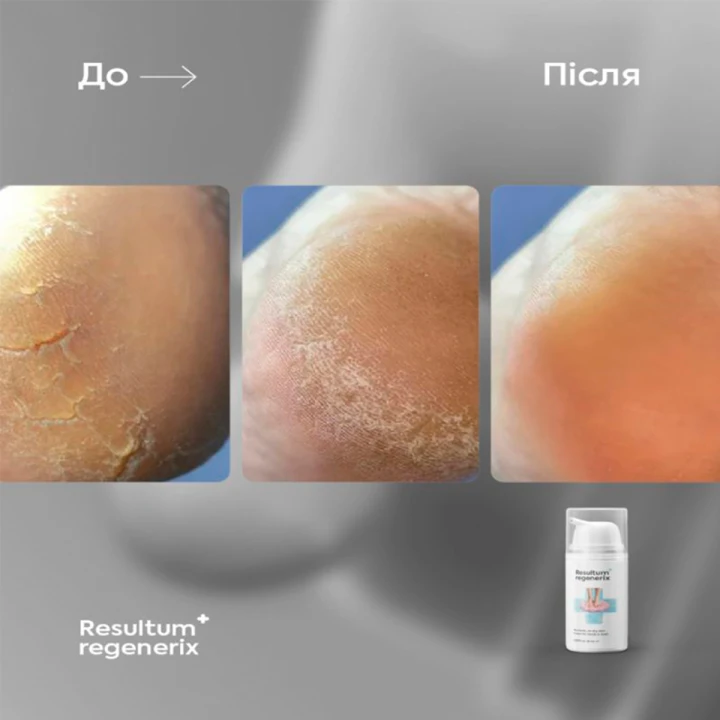 Крем от трещин для рук и стоп RESULTUM (Regenerix 25 мл)