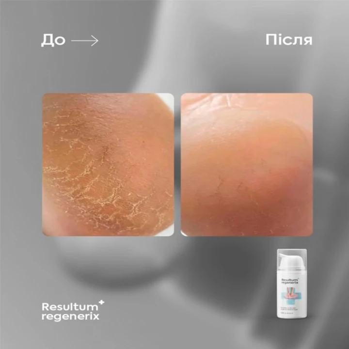 Крем от трещин для рук и стоп RESULTUM (Regenerix 50 мл)