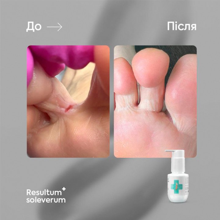 Мыло регенерирующее для рук и ног RESULTUM (Soleverum 150 мл)