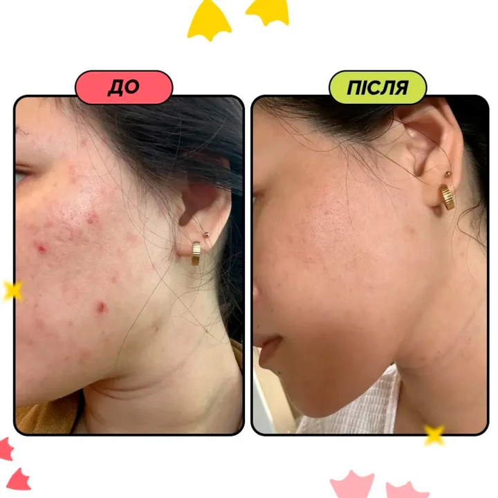 Устройство для электрического неинвазивного микронидлинга и сужения пор Medicube (AGE-R ATS Air Shot)